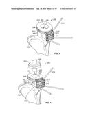 Graft Cartilage Management Systems and Methods diagram and image