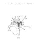 Graft Cartilage Management Systems and Methods diagram and image