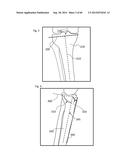 METHOD TO MEASURE MEDIAL-LATERAL OFFSET RELATIVE TO A MECHANICAL AXIS diagram and image