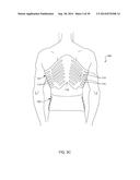 Distraction and Mobility Back Support diagram and image