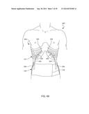 Distraction and Mobility Back Support diagram and image