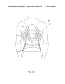 Distraction and Mobility Back Support diagram and image