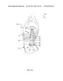 Distraction and Mobility Back Support diagram and image