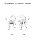 Distraction and Mobility Back Support diagram and image