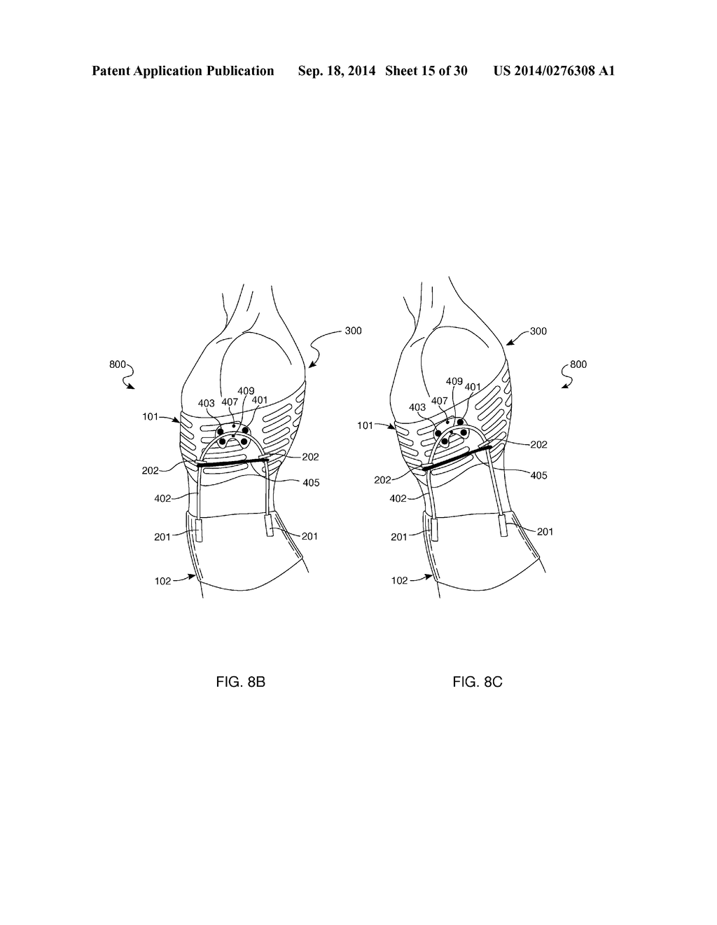 Distraction and Mobility Back Support - diagram, schematic, and image 16