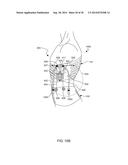 Distraction and Mobility Back Support diagram and image