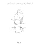 Distraction and Mobility Back Support diagram and image