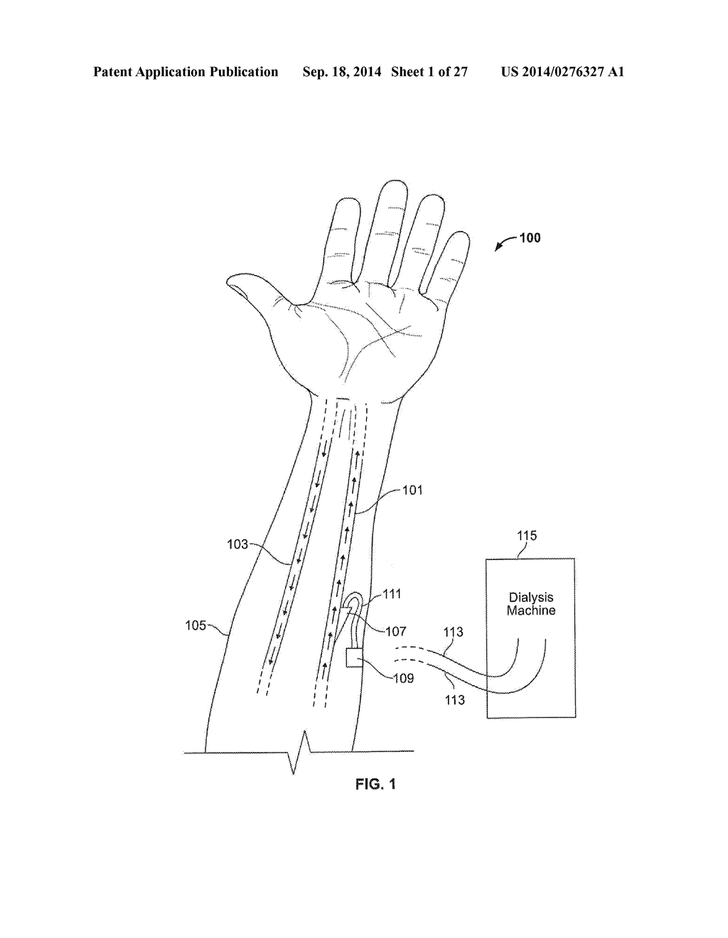 HYDRAULICALLY CONTROLLED ARTERIAL/VENOUS ACCESS - diagram, schematic, and image 02