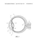 GLAUCOMA STENT AND METHODS THEREOF FOR GLAUCOMA TREATMENT diagram and image