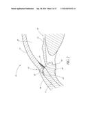 GLAUCOMA STENT AND METHODS THEREOF FOR GLAUCOMA TREATMENT diagram and image