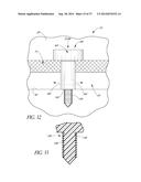 GLAUCOMA STENT AND METHODS THEREOF FOR GLAUCOMA TREATMENT diagram and image