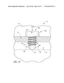 GLAUCOMA STENT AND METHODS THEREOF FOR GLAUCOMA TREATMENT diagram and image