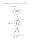 GLAUCOMA STENT AND METHODS THEREOF FOR GLAUCOMA TREATMENT diagram and image