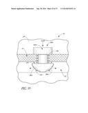 GLAUCOMA STENT AND METHODS THEREOF FOR GLAUCOMA TREATMENT diagram and image