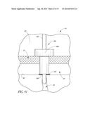 GLAUCOMA STENT AND METHODS THEREOF FOR GLAUCOMA TREATMENT diagram and image