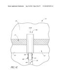 GLAUCOMA STENT AND METHODS THEREOF FOR GLAUCOMA TREATMENT diagram and image