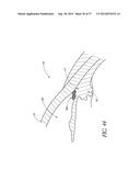 GLAUCOMA STENT AND METHODS THEREOF FOR GLAUCOMA TREATMENT diagram and image