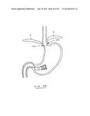 DEVICES AND METHODS FOR GASTROINTESTINAL BYPASS diagram and image