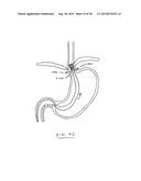 DEVICES AND METHODS FOR GASTROINTESTINAL BYPASS diagram and image