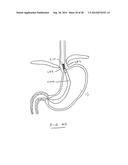 DEVICES AND METHODS FOR GASTROINTESTINAL BYPASS diagram and image