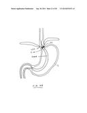 DEVICES AND METHODS FOR GASTROINTESTINAL BYPASS diagram and image