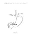 DEVICES AND METHODS FOR GASTROINTESTINAL BYPASS diagram and image