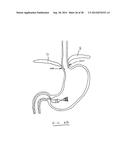 DEVICES AND METHODS FOR GASTROINTESTINAL BYPASS diagram and image