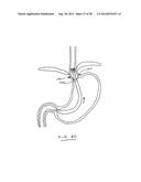 DEVICES AND METHODS FOR GASTROINTESTINAL BYPASS diagram and image