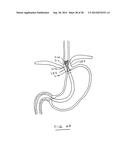 DEVICES AND METHODS FOR GASTROINTESTINAL BYPASS diagram and image