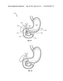 Implantable Devices with Delivery Systems and Methods for Blocking     Digestive Neurohormonal Pathways in Mammals diagram and image