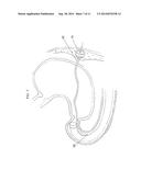 SYSTEM AND METHOD FOR GASTRIC RESTRICTION AND MALABSORPTION diagram and image