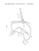 SYSTEM AND METHOD FOR GASTRIC RESTRICTION AND MALABSORPTION diagram and image