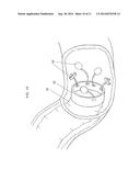 SYSTEM AND METHOD FOR GASTRIC RESTRICTION AND MALABSORPTION diagram and image