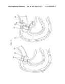 SYSTEM AND METHOD FOR GASTRIC RESTRICTION AND MALABSORPTION diagram and image