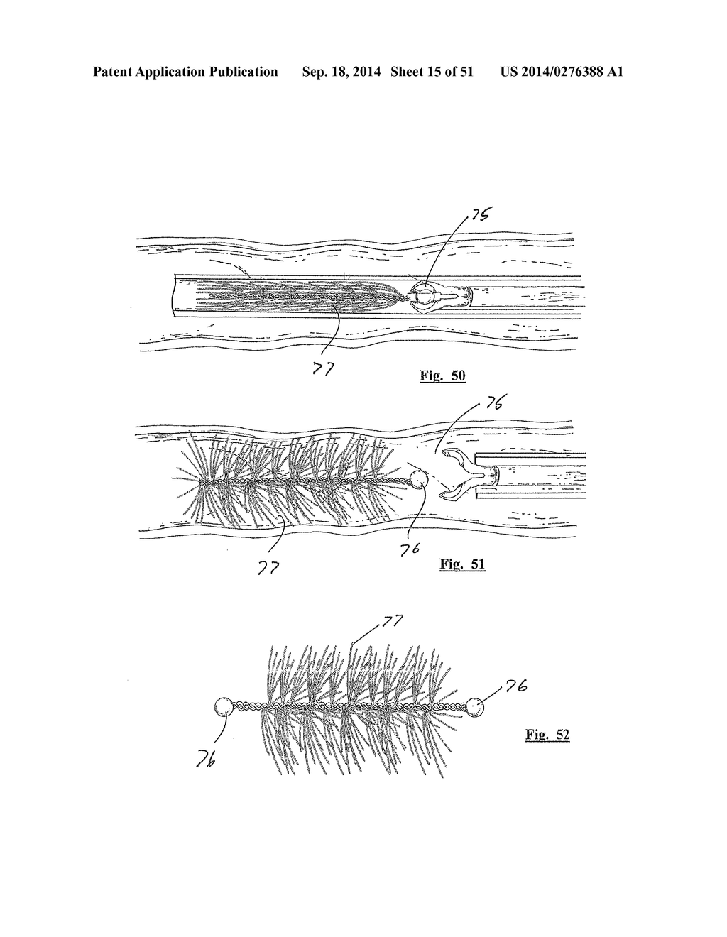 EMBOLIZATION SYSTEMS - diagram, schematic, and image 16