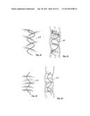 EMBOLIZATION SYSTEMS diagram and image