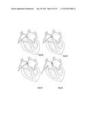 EMBOLIZATION SYSTEMS diagram and image