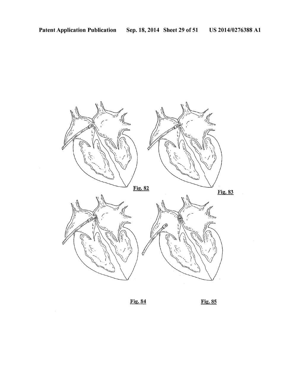 EMBOLIZATION SYSTEMS - diagram, schematic, and image 30