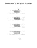 EMBOLIZATION SYSTEMS diagram and image