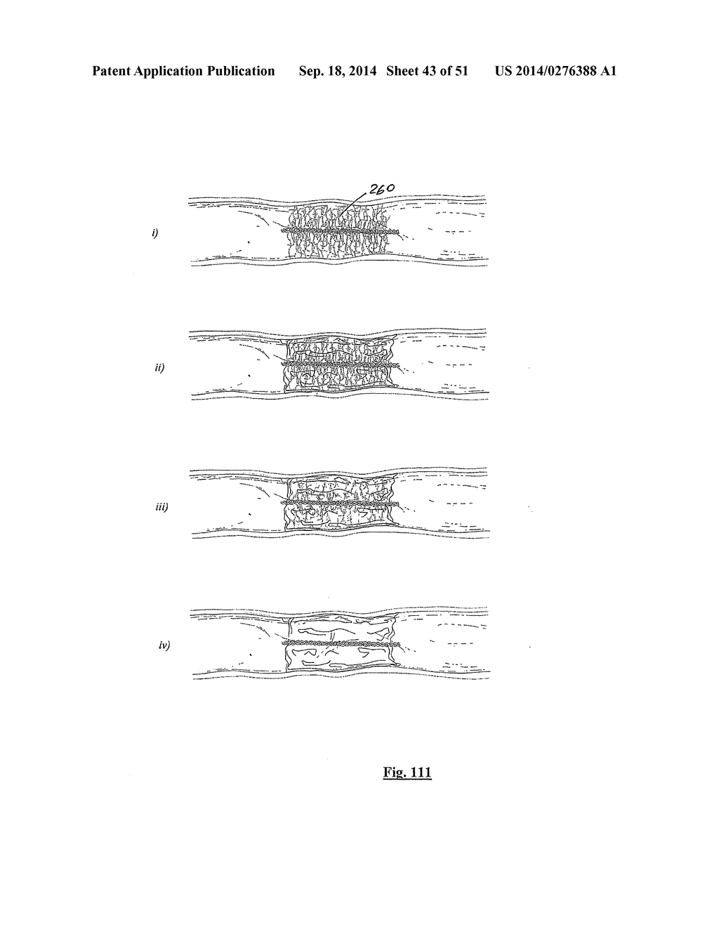 EMBOLIZATION SYSTEMS - diagram, schematic, and image 44