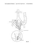EMBOLIZATION SYSTEMS diagram and image