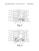 Device for Selectively Reducing Absorption of Unhealthy Food diagram and image