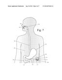 Device for Selectively Reducing Absorption of Unhealthy Food diagram and image