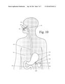 Device for Selectively Reducing Absorption of Unhealthy Food diagram and image