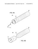 DECONSTRUCTABLE ENDOLUMINAL DEVICES AND RELATED SYSTEMS AND METHODS diagram and image