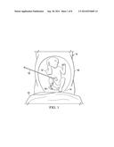 Fetal Intervention Using Magnetically-Guided Navigation diagram and image