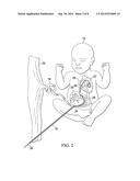 Fetal Intervention Using Magnetically-Guided Navigation diagram and image