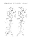 CATHETER-BASED DEVICES AND METHODS FOR IDENTIFYING SPECIFIC ANATOMICAL     LANDMARKS OF THE HUMAN AORTIC VALVE diagram and image