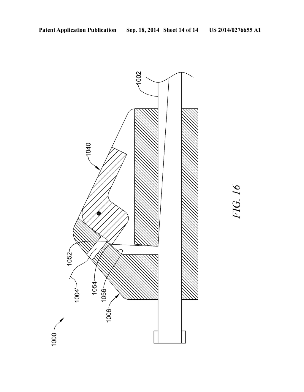 DRAINAGE CATHETER WITH CUTTING TOOL - diagram, schematic, and image 15