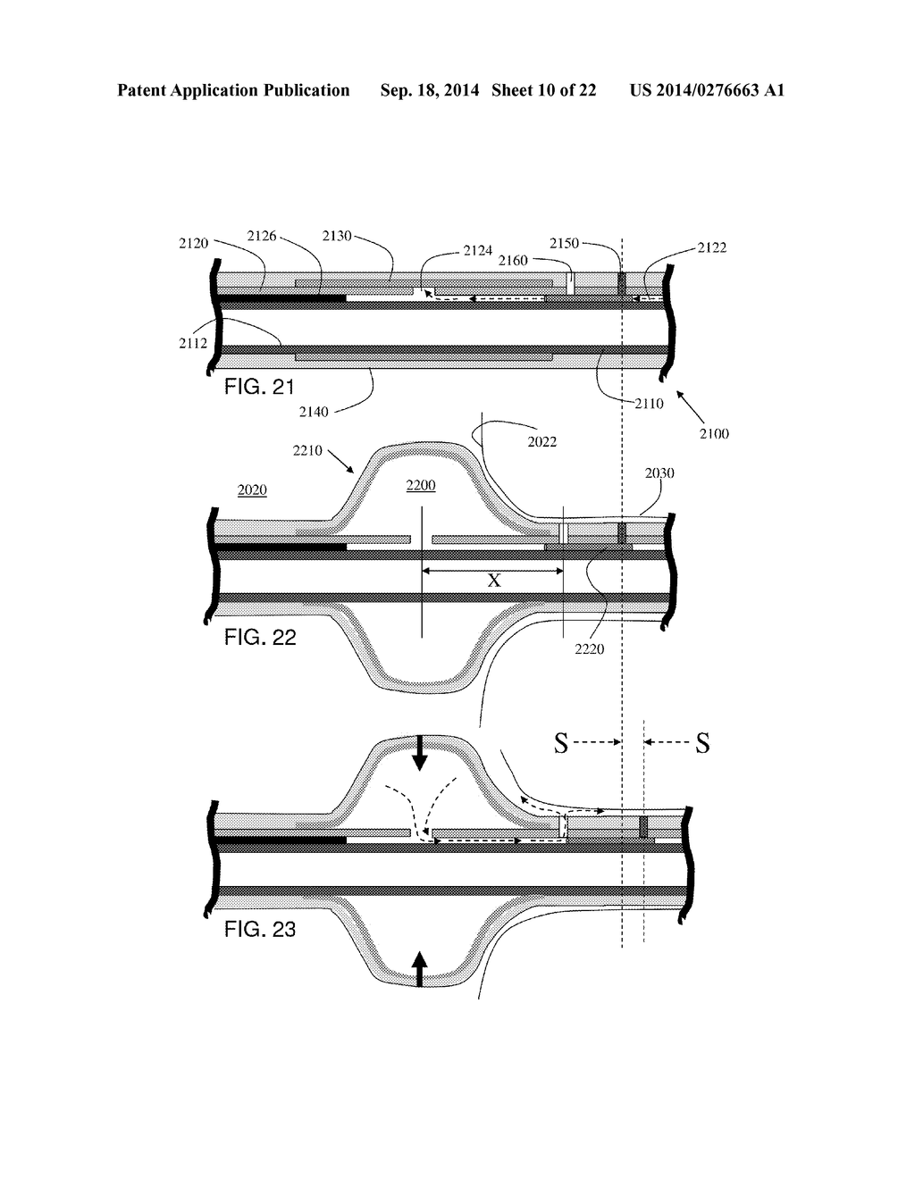 Stretch Valve Balloon Catheter and Methods for Producing and Using Same - diagram, schematic, and image 11